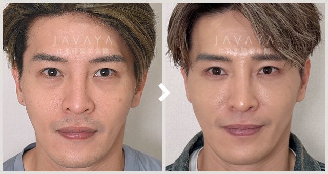 隱痕眼袋手術案例